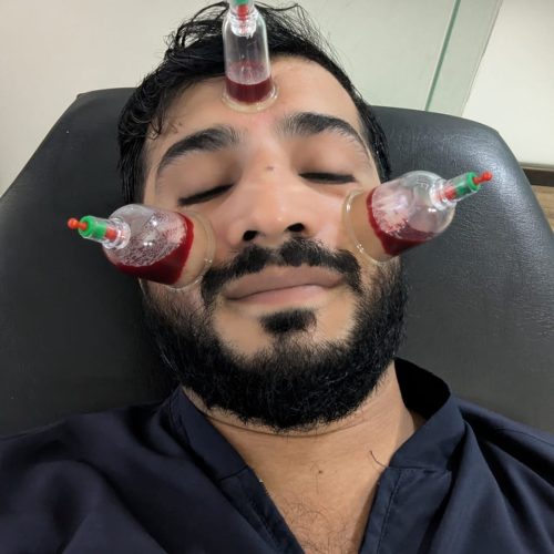 Cupping Therapy By Dr Waseem