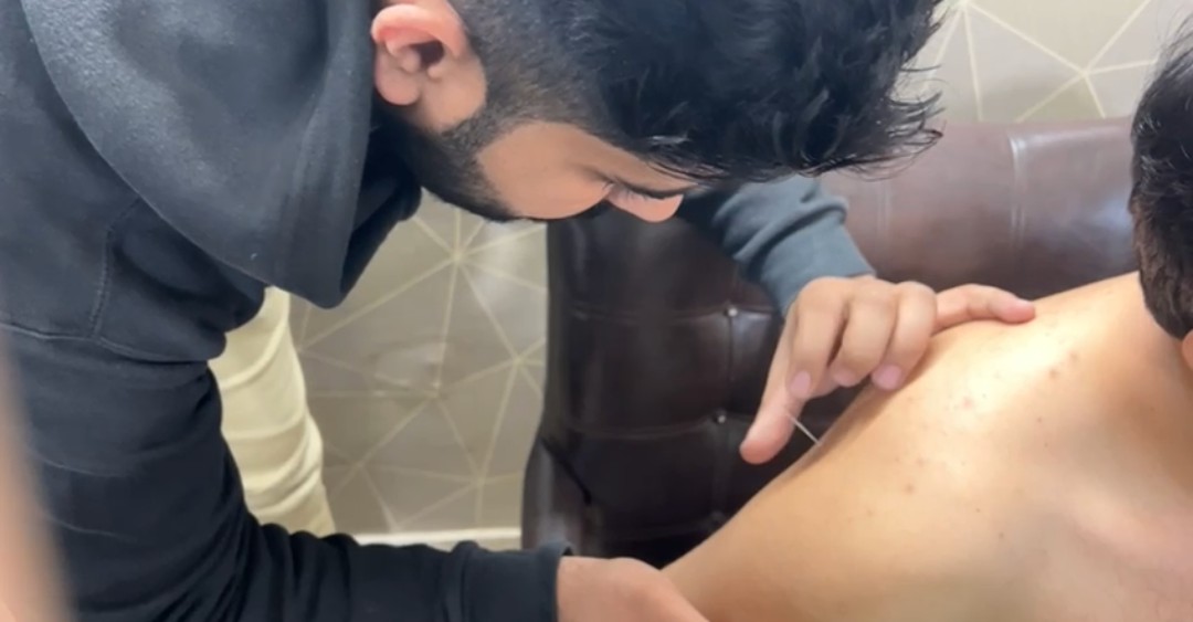 Dry Needling Treatment Work