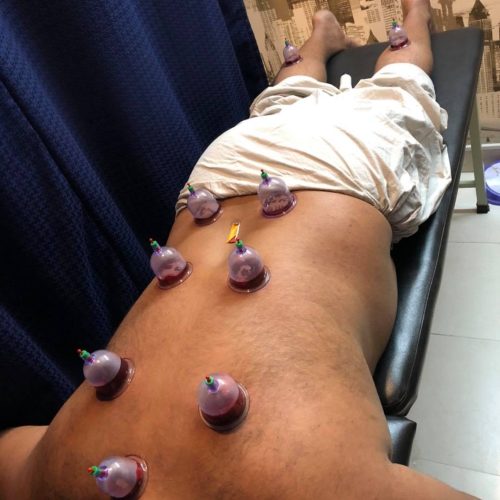 What Is Cupping Therapy